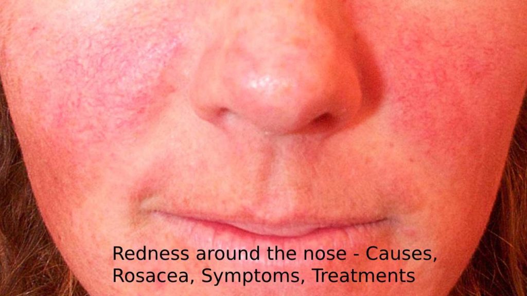 Redness around the nose - Causes, Rosacea, Symptoms, Treatments