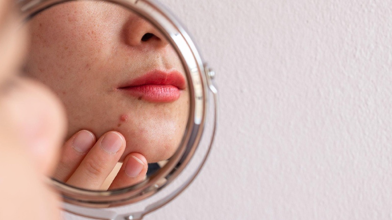 What is Hormonal Acne?