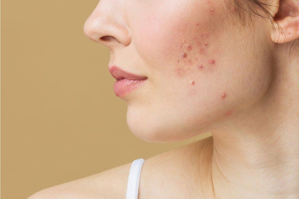 Hormonal Acne Write For Us