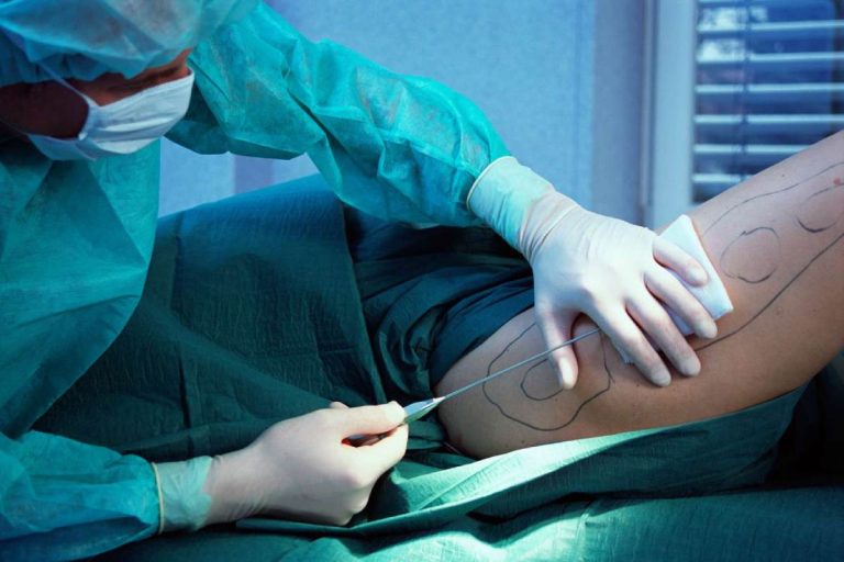 What is Liposuction and Who is it for
